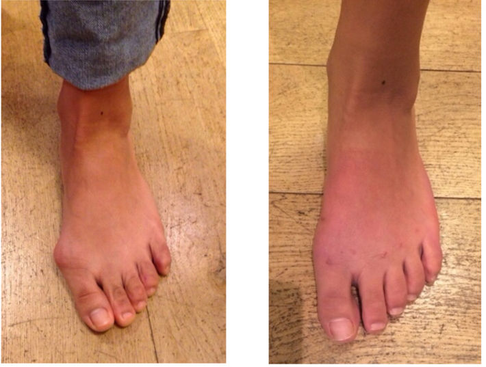 OrthoBounce Schuhe Zentiv 🇩🇪 🇦🇹